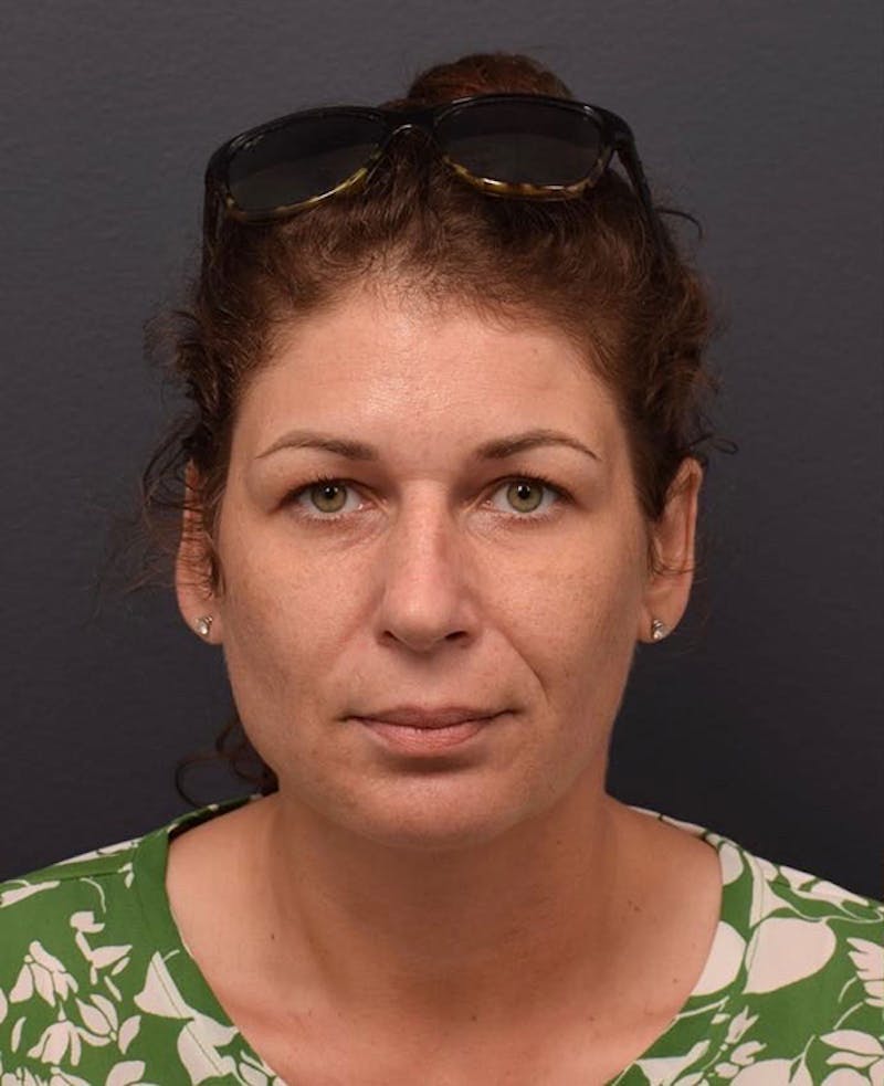 Cosmetic Surgical Before & After Gallery - Patient 63360942 - Image 1