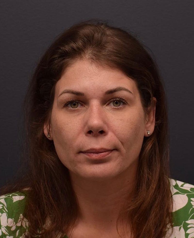 Cosmetic Surgical Before & After Gallery - Patient 63360942 - Image 2