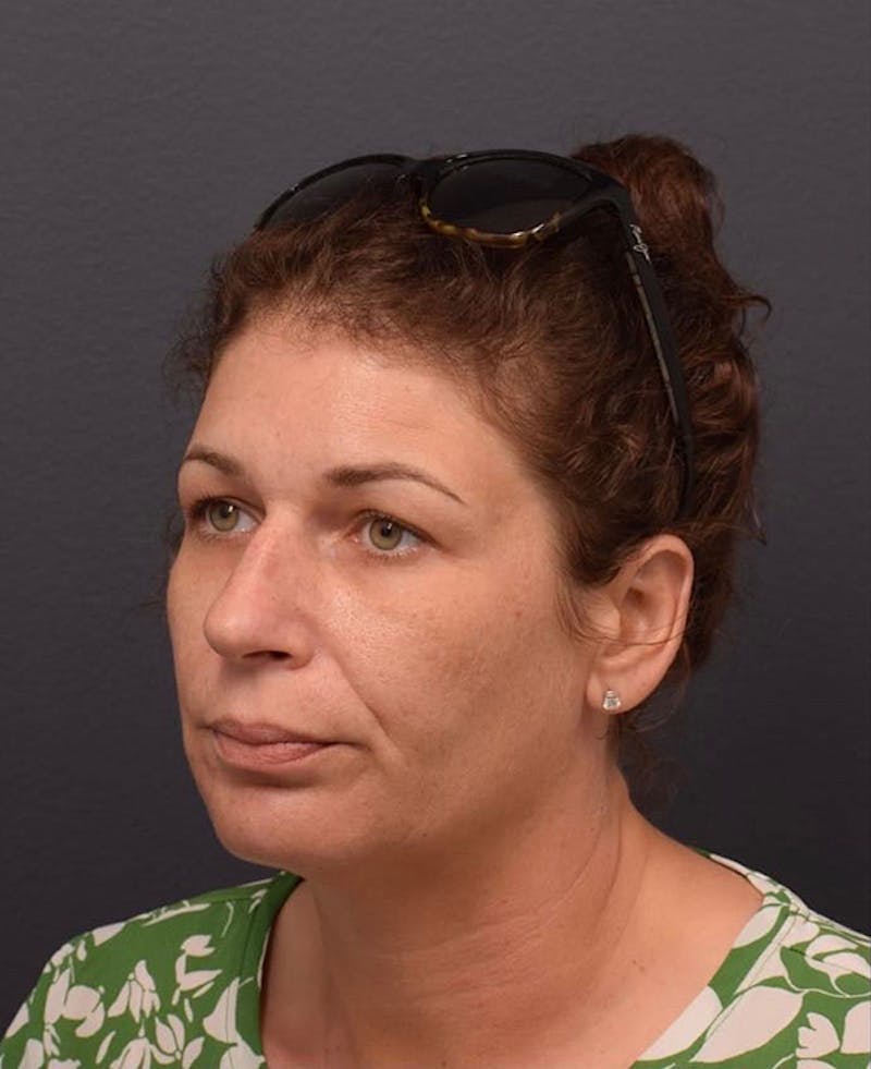 Cosmetic Surgical Before & After Gallery - Patient 63360942 - Image 3