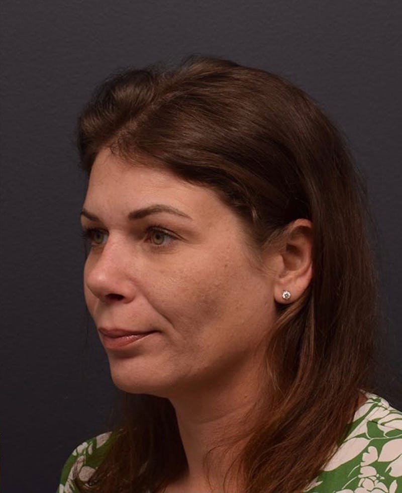 Cosmetic Surgical Before & After Gallery - Patient 63360942 - Image 4