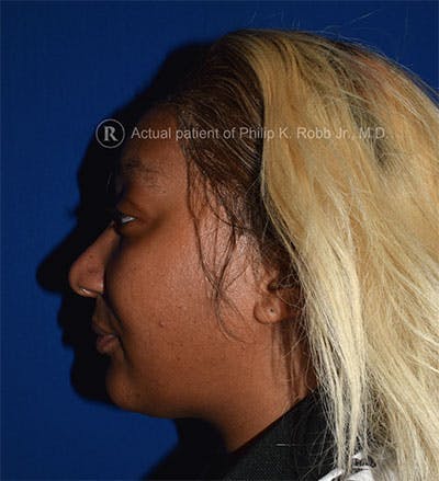 Cosmetic Surgical Before & After Gallery - Patient 63360943 - Image 1