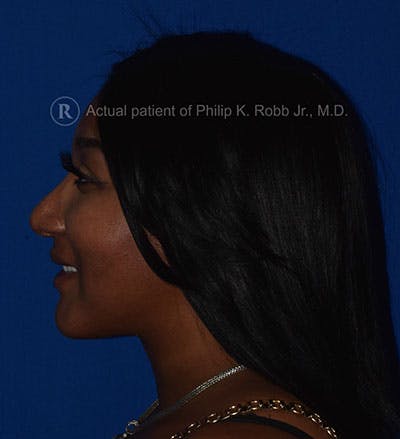 Cosmetic Surgical Before & After Gallery - Patient 63360943 - Image 2