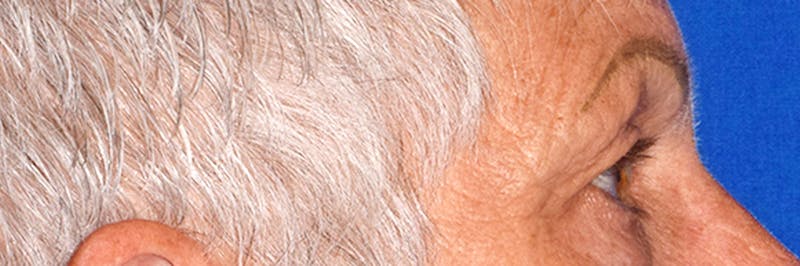 Face Before & After Gallery - Patient 63360944 - Image 6