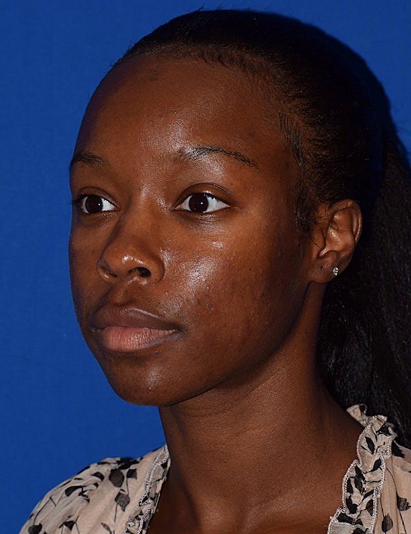 Face Before & After Gallery - Patient 63360945 - Image 1