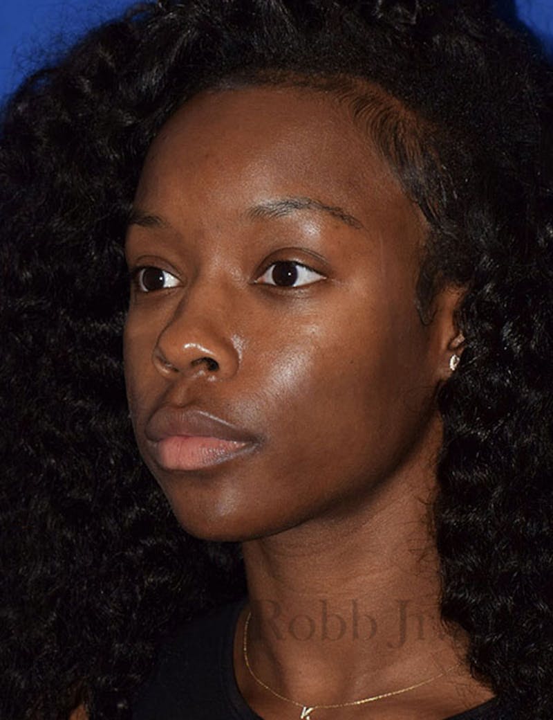 Face Before & After Gallery - Patient 63360945 - Image 2