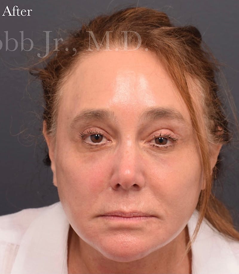 Face Before & After Gallery - Patient 63360951 - Image 2