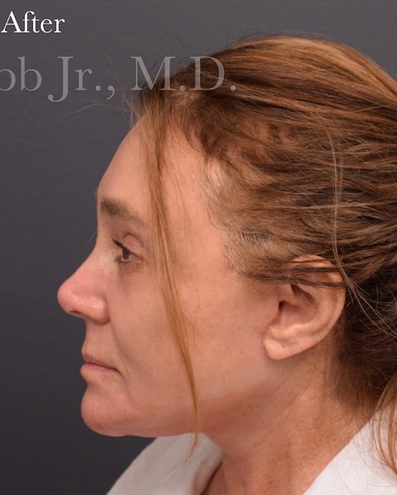 Cosmetic Surgical Before & After Gallery - Patient 63360951 - Image 4
