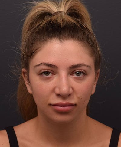Cosmetic Surgical Before & After Gallery - Patient 63360952 - Image 1