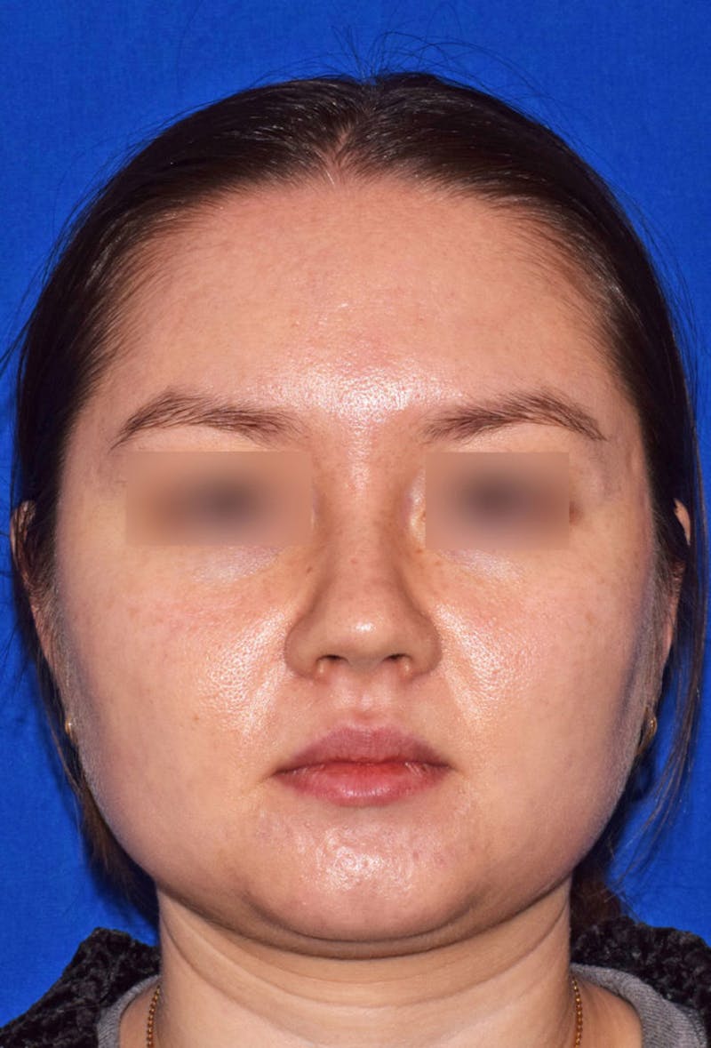 Face Before & After Gallery - Patient 63360955 - Image 1