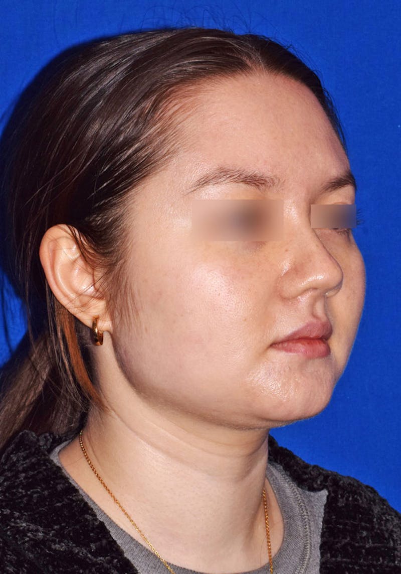 Face Before & After Gallery - Patient 63360955 - Image 3