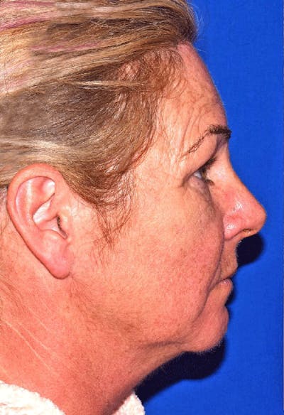 Cosmetic Surgical Before & After Gallery - Patient 63360956 - Image 1