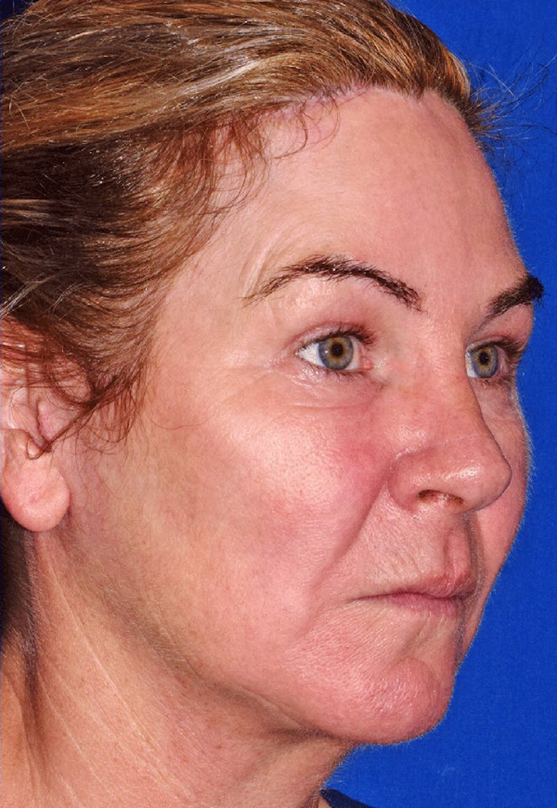 Cosmetic Surgical Before & After Gallery - Patient 63360956 - Image 4