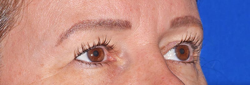 Face Before & After Gallery - Patient 63360958 - Image 3
