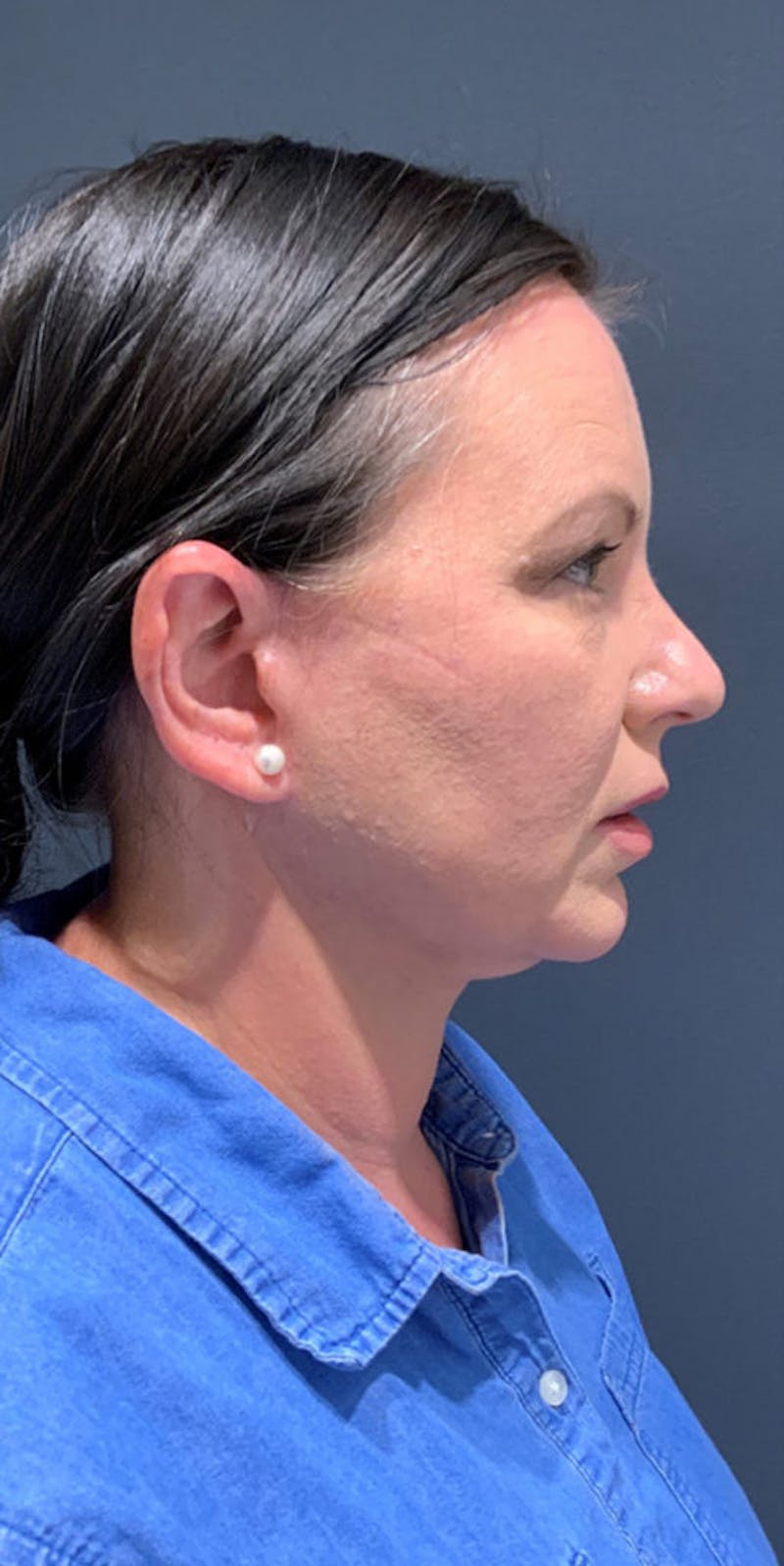 Face Before & After Gallery - Patient 63360962 - Image 3