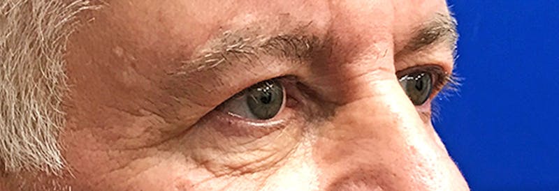Face Before & After Gallery - Patient 63360966 - Image 3