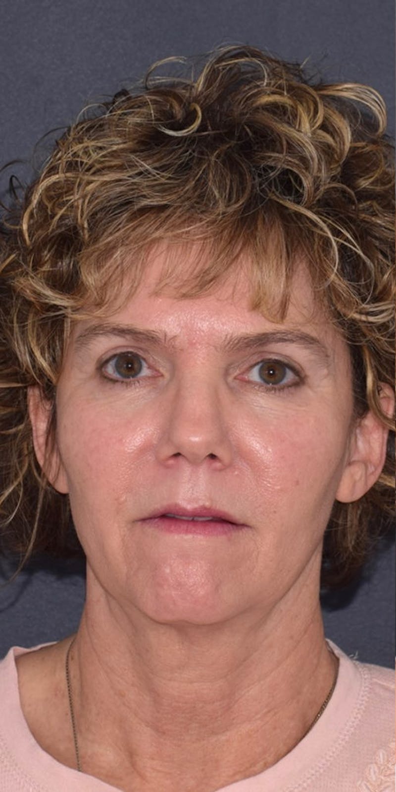 Face Before & After Gallery - Patient 63360968 - Image 1