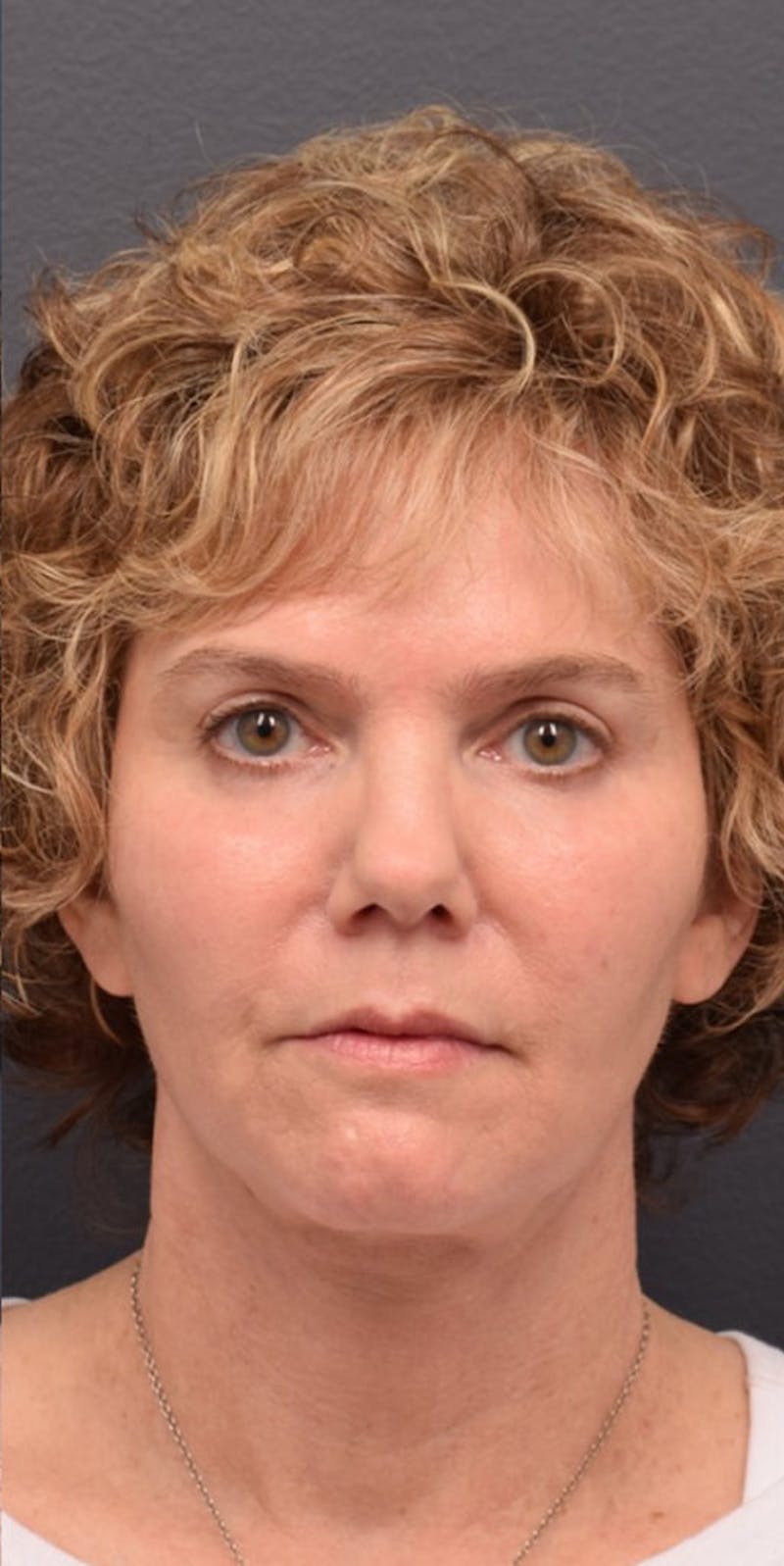 Face Before & After Gallery - Patient 63360968 - Image 2