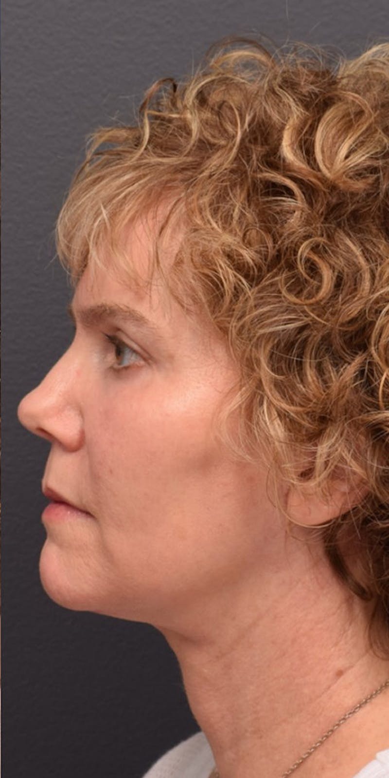 Face Before & After Gallery - Patient 63360968 - Image 6
