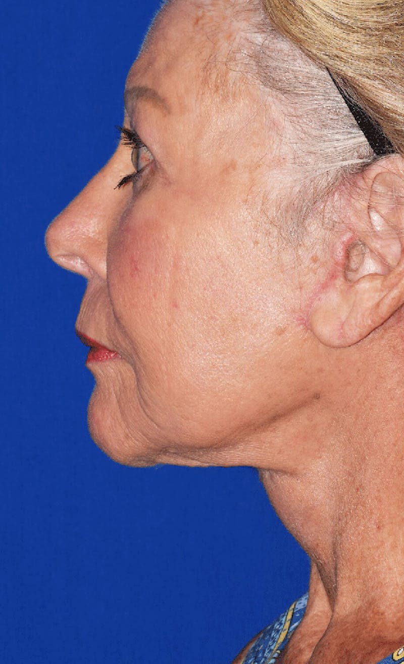 Cosmetic Surgical Before & After Gallery - Patient 63360972 - Image 2