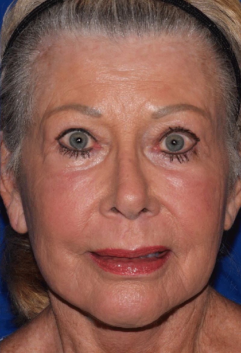 Face Before & After Gallery - Patient 63360972 - Image 6