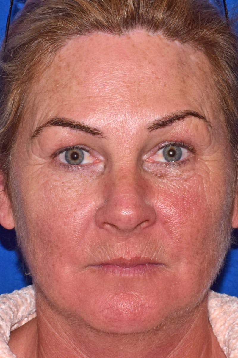 Cosmetic Surgical Before & After Gallery - Patient 63360973 - Image 1
