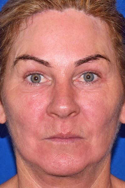 Face Before & After Gallery - Patient 63360973 - Image 2