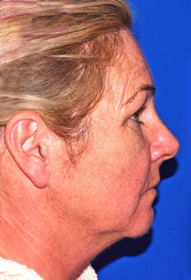 Cosmetic Surgical Before & After Gallery - Patient 63360973 - Image 5