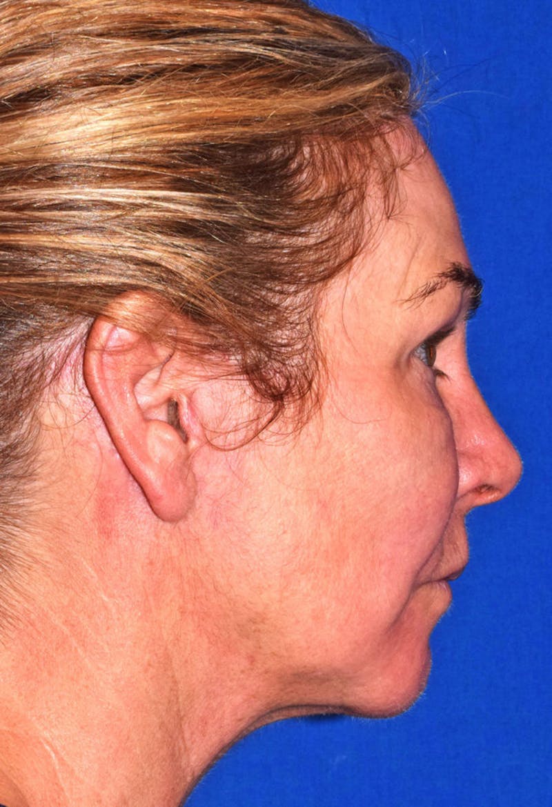 Face Before & After Gallery - Patient 63360973 - Image 6