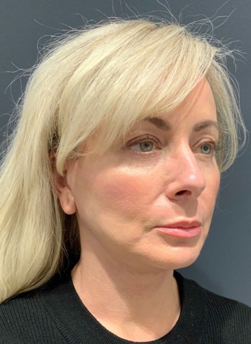 Face Before & After Gallery - Patient 63360975 - Image 4