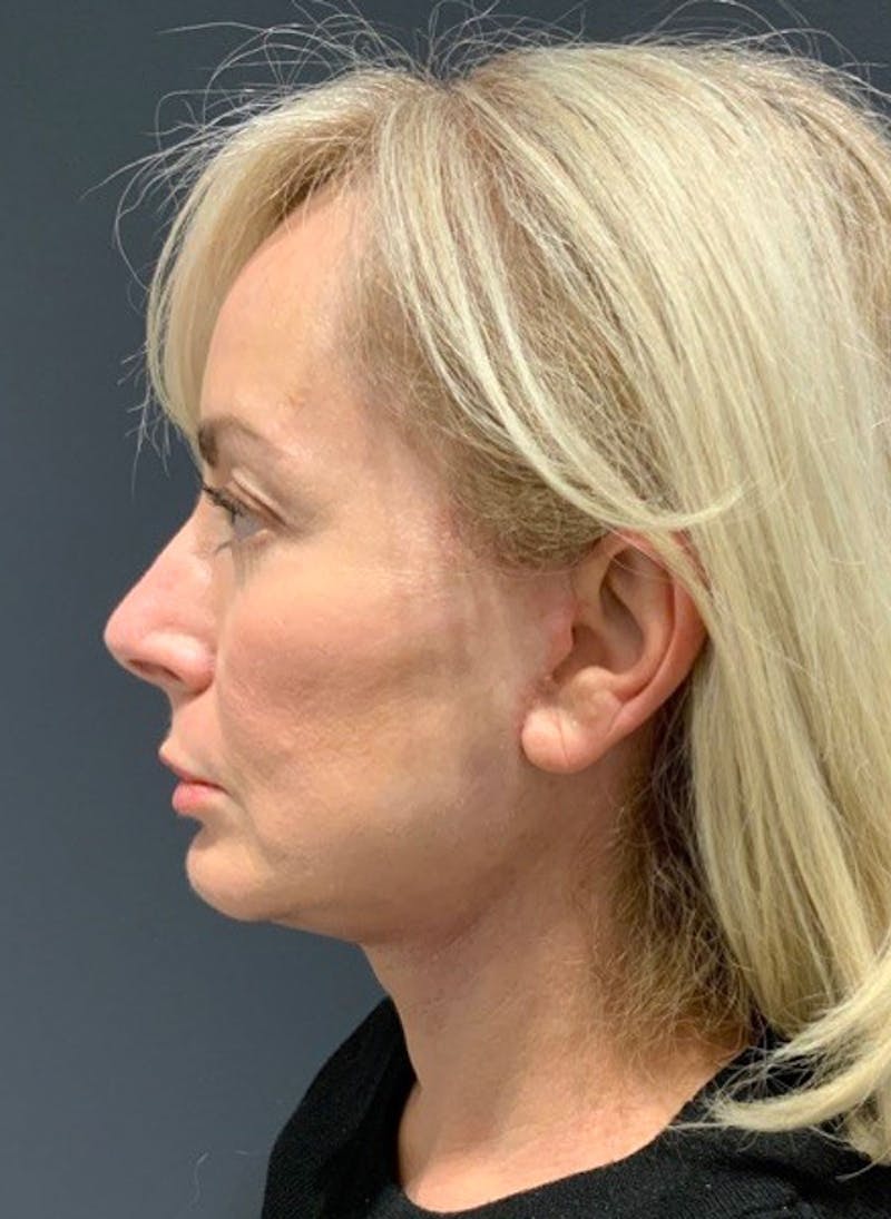 Face Before & After Gallery - Patient 63360975 - Image 10