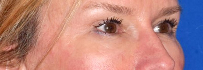 Face Before & After Gallery - Patient 63360978 - Image 4