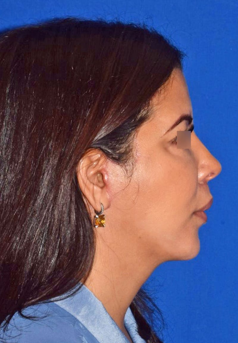 Cosmetic Surgical Before & After Gallery - Patient 63360979 - Image 2