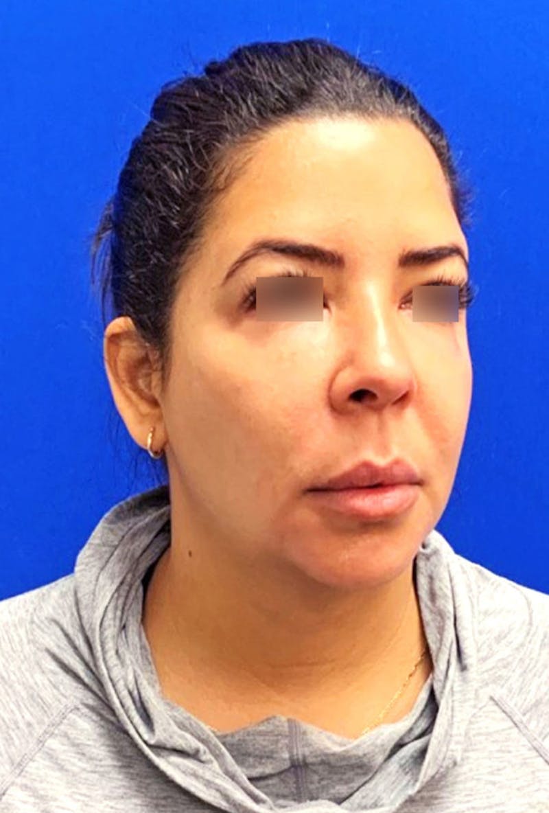 Face Before & After Gallery - Patient 63360979 - Image 3