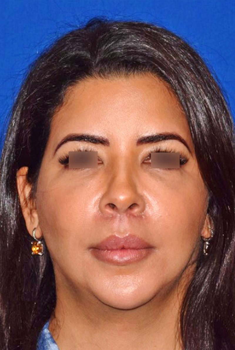 Cosmetic Surgical Before & After Gallery - Patient 63360979 - Image 6
