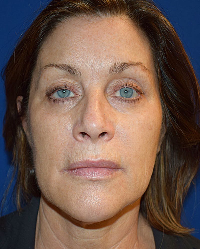 Face Before & After Gallery - Patient 63360985 - Image 1