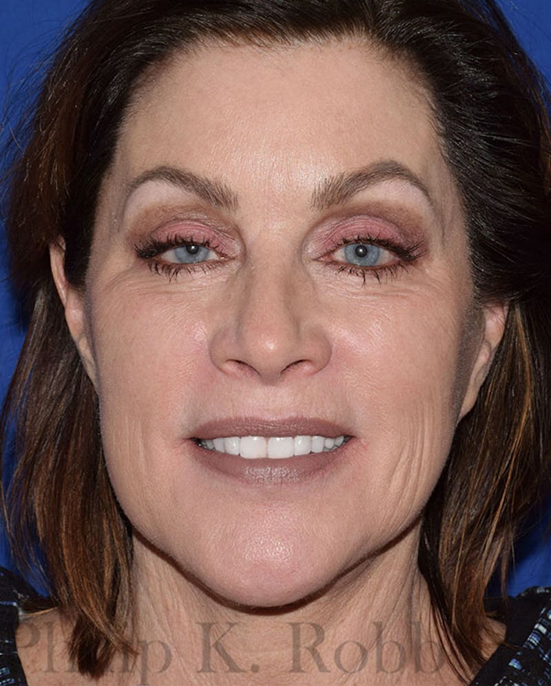 Face Before & After Gallery - Patient 63360985 - Image 2
