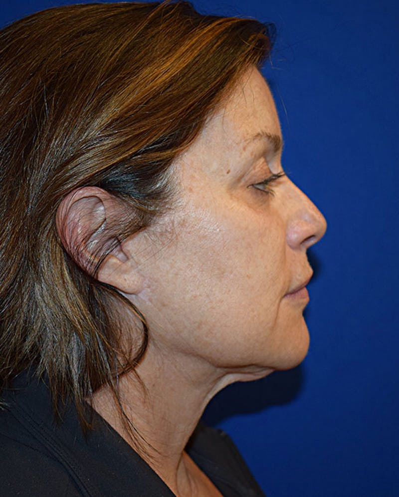 Cosmetic Surgical Before & After Gallery - Patient 63360985 - Image 5