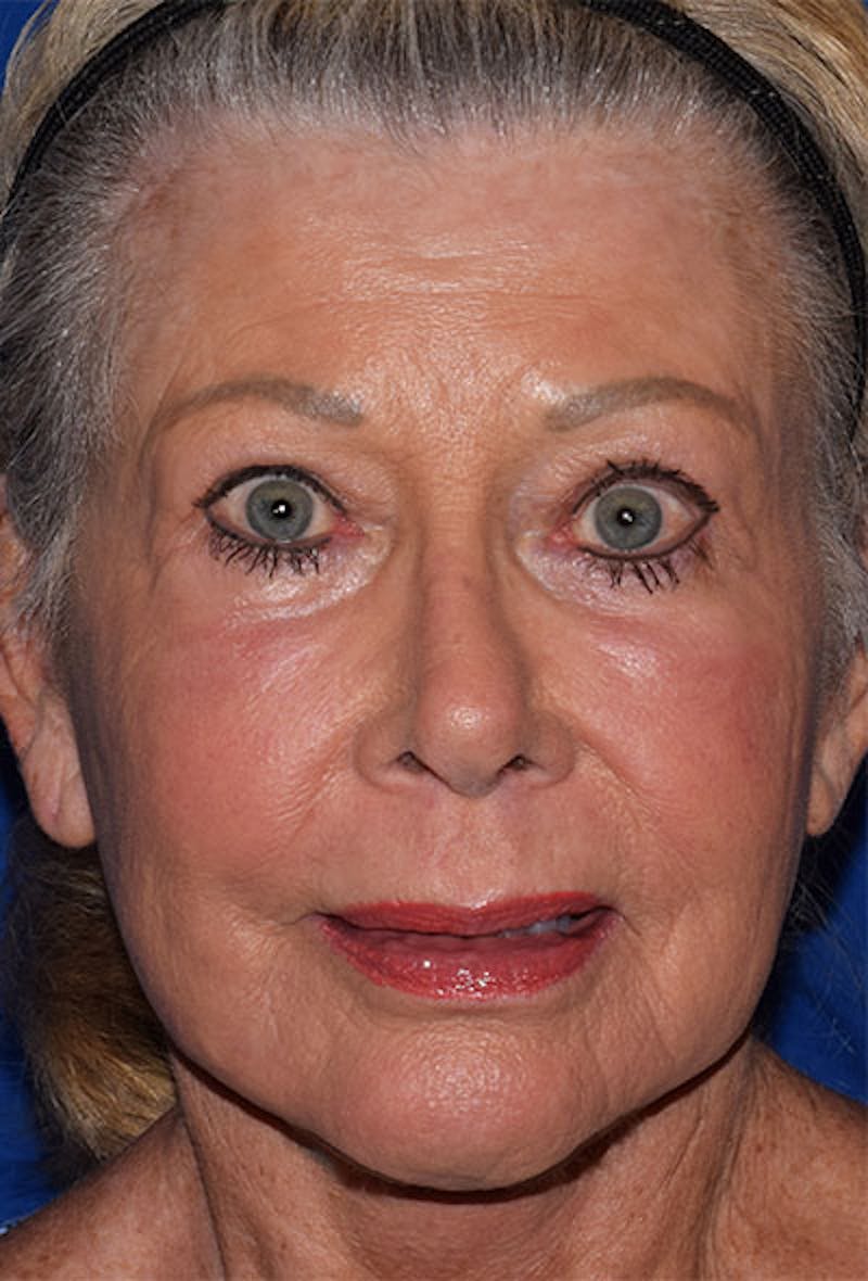 Face Before & After Gallery - Patient 63360992 - Image 2