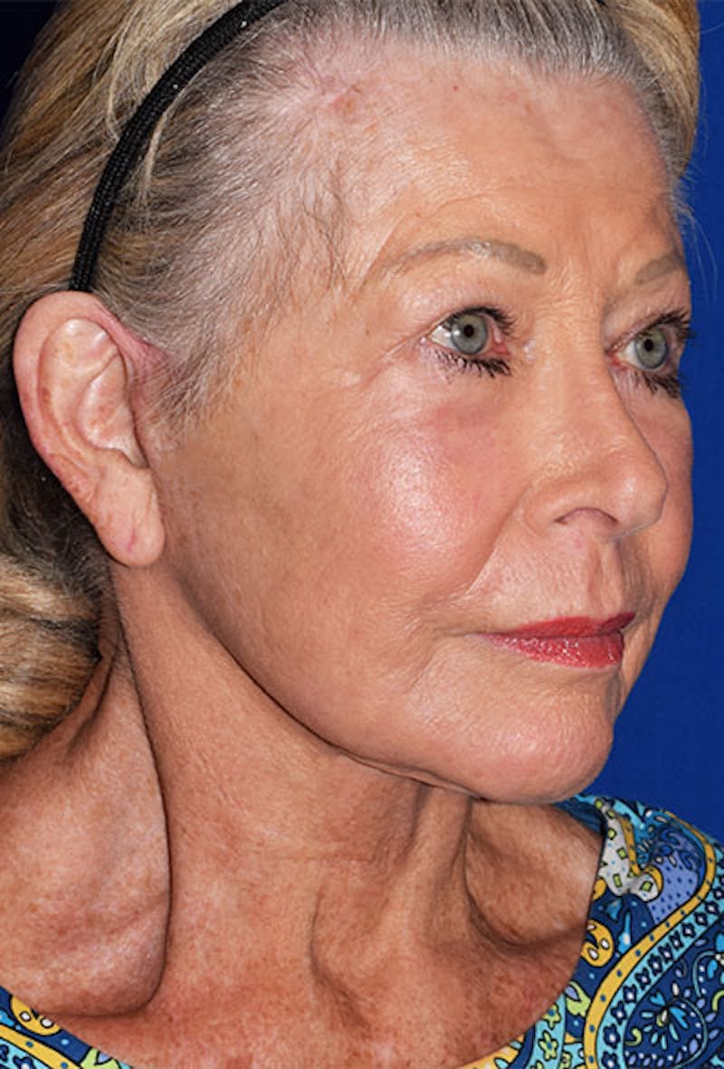 Face Before & After Gallery - Patient 63360992 - Image 6
