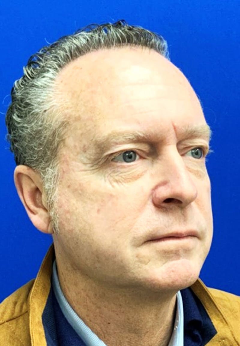 Face Before & After Gallery - Patient 63360994 - Image 3