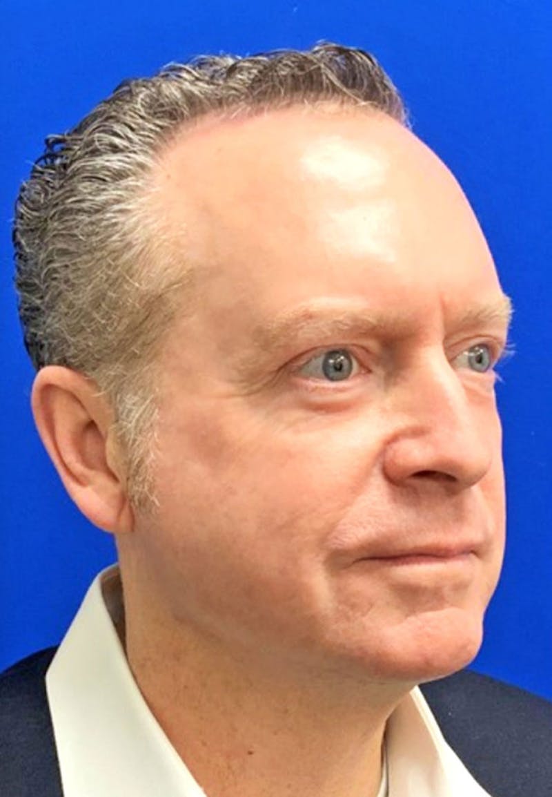 Face Before & After Gallery - Patient 63360994 - Image 4