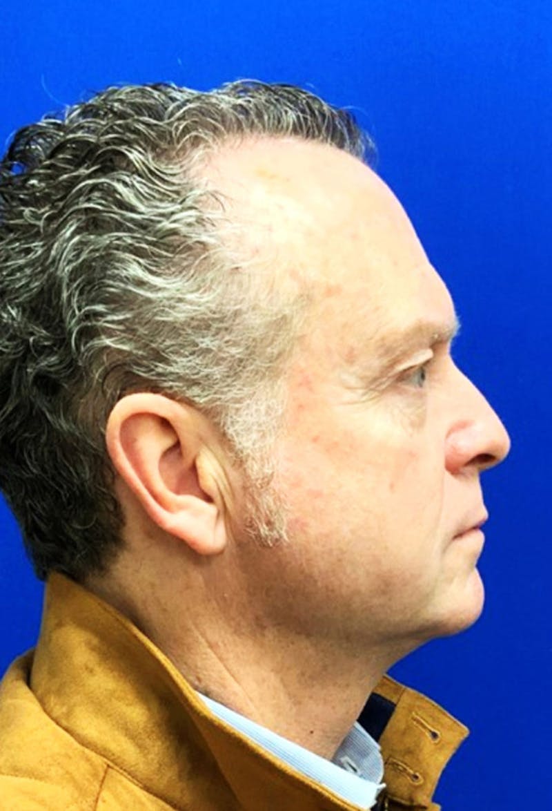 Face Before & After Gallery - Patient 63360994 - Image 5
