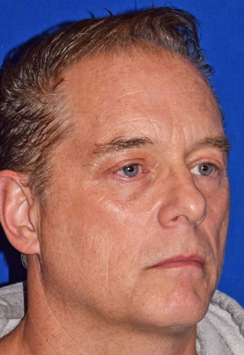 Face Before & After Gallery - Patient 63360997 - Image 4