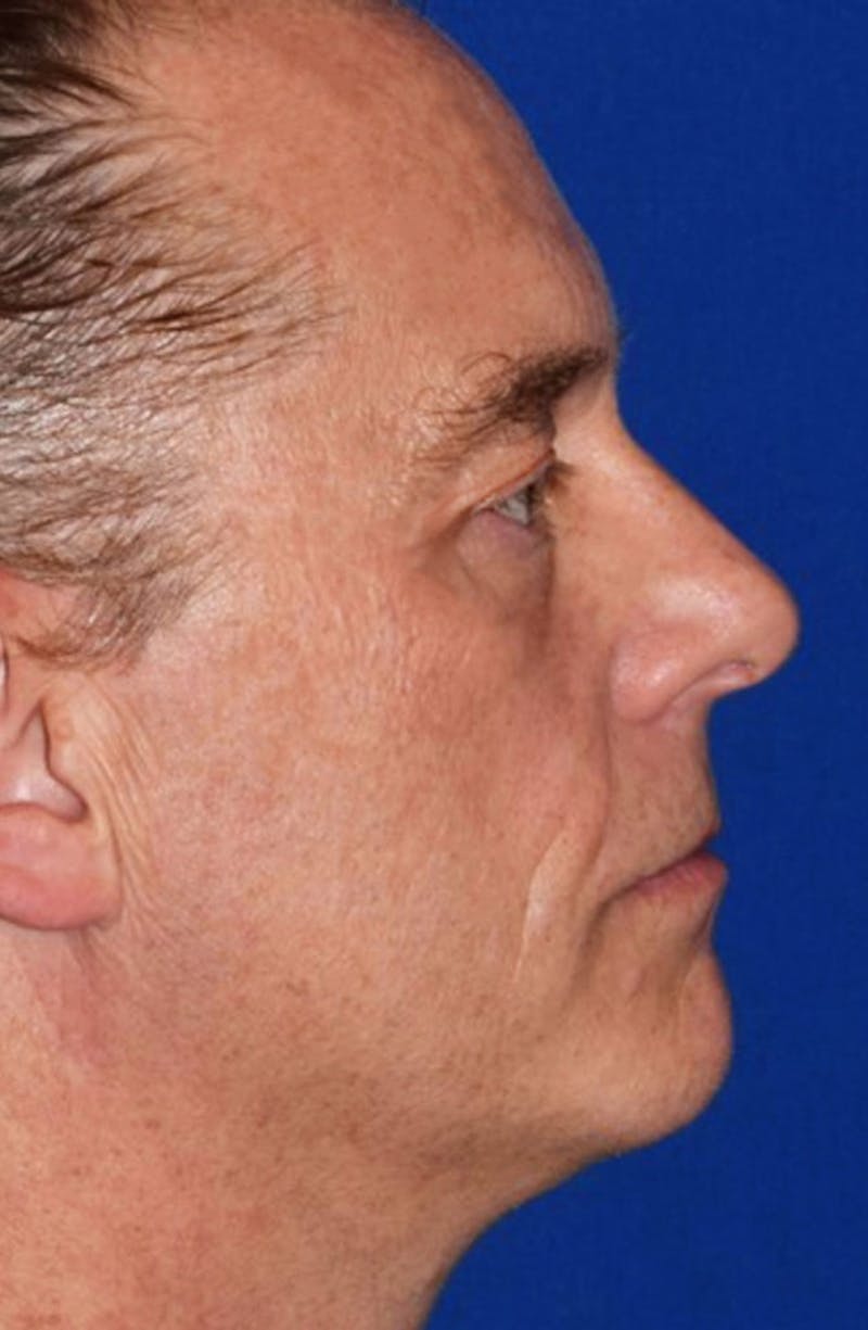 Cosmetic Surgical Before & After Gallery - Patient 63360997 - Image 6