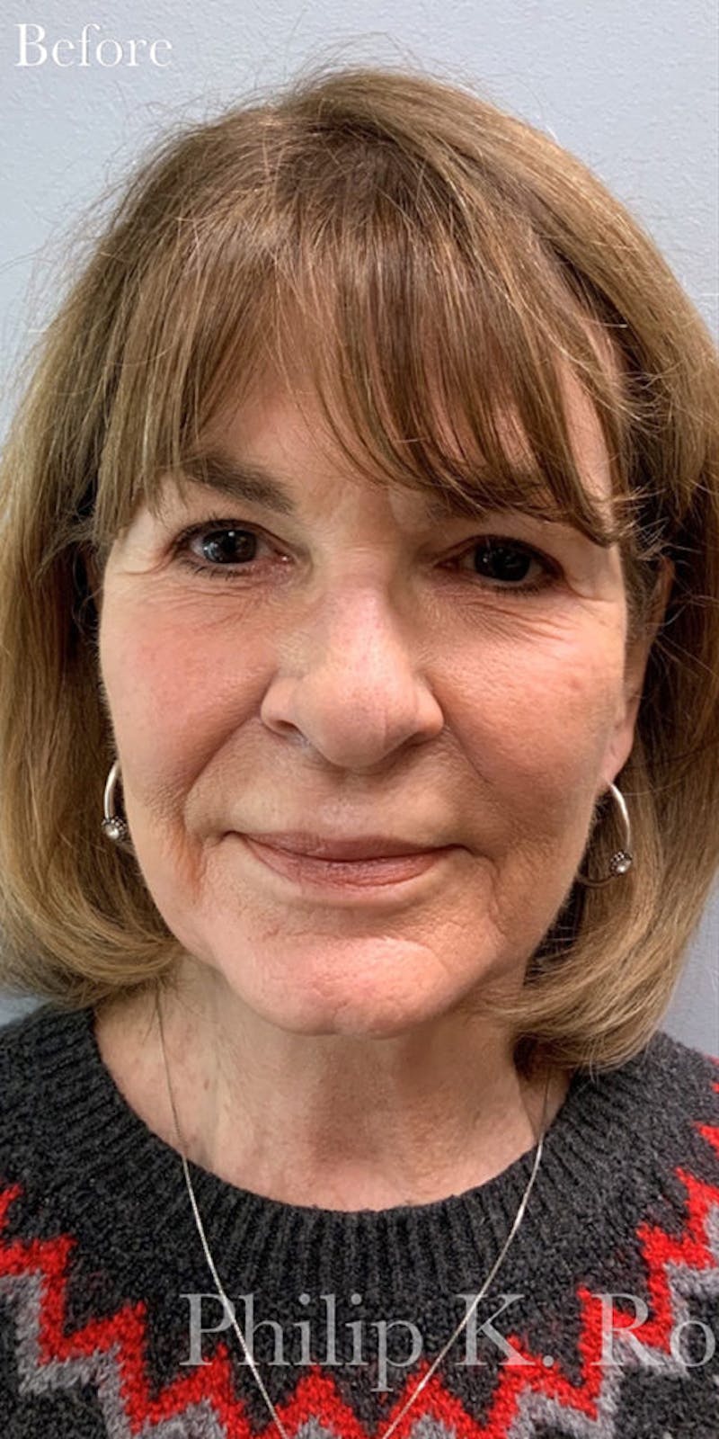 Face Before & After Gallery - Patient 63361000 - Image 1