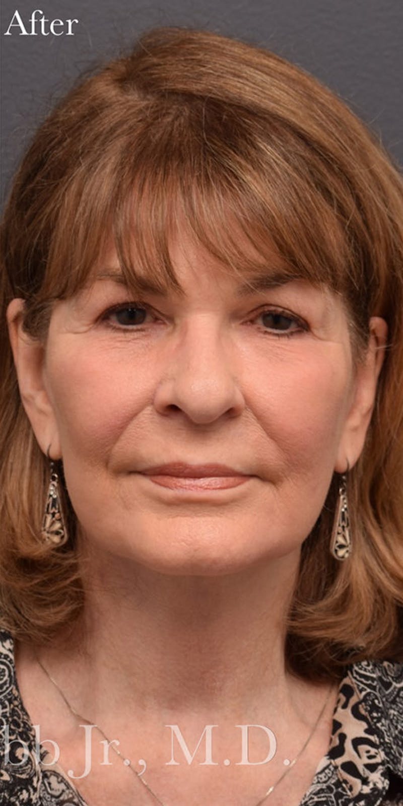 Face Before & After Gallery - Patient 63361000 - Image 2