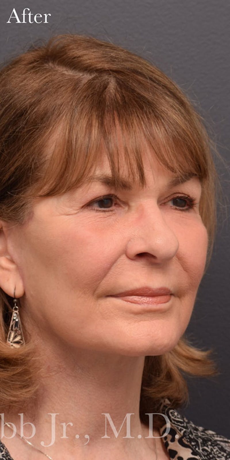 Face Before & After Gallery - Patient 63361000 - Image 4