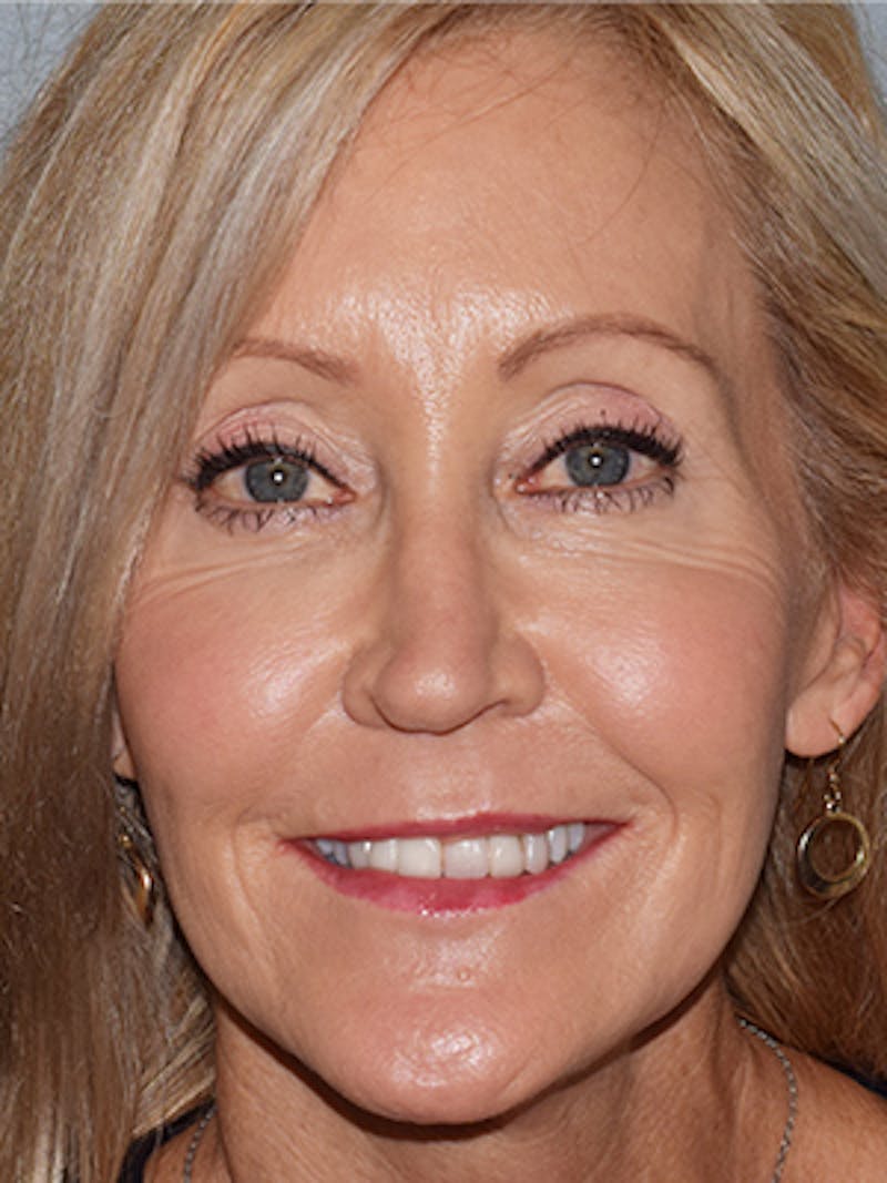 Face Before & After Gallery - Patient 63361003 - Image 2
