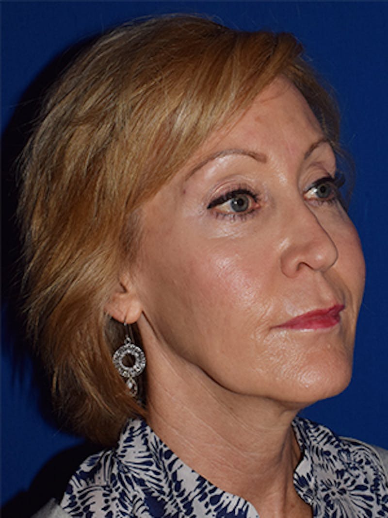 Face Before & After Gallery - Patient 63361003 - Image 5