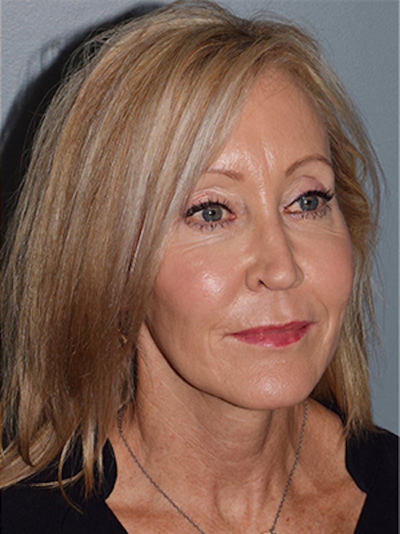 Face Before & After Gallery - Patient 63361003 - Image 6